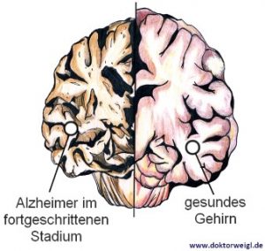 Doktor Weigl Erklärt Alzheimer - Ein Langsamer Verfall Der Denkfähigkeit